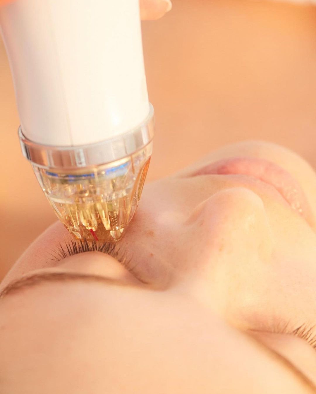 Woman receiving a cosmetic treatment on her face with a specialized tool; close-up view of procedure and facial features.