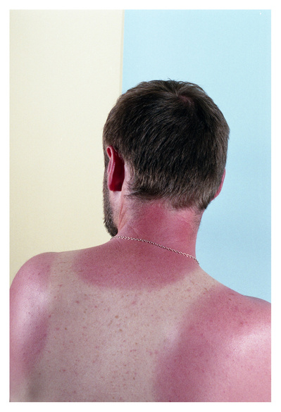 Back view of an adult man with sunburn on his shoulders and neck against a split yellow and blue background. Indoor studio lighting.