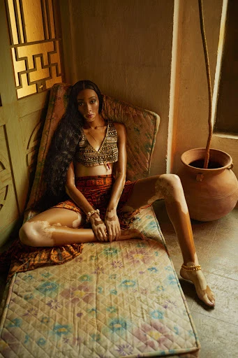 Woman with vitiligo poses on a mattress indoors, wearing a crop top and skirt, seated beside a potted plant in soft, natural light.