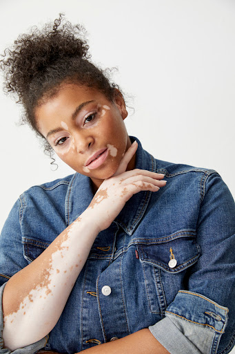 A woman with vitiligo poses in a denim jacket against a white background in a portrait. The woman has curly hair in an updo.