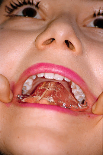 Close-up of a person's mouth with an upper dental prosthesis held in place, revealing teeth, lips, and surrounding facial features.