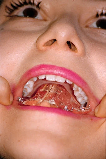 Close-up of a person's mouth with an upper dental prosthesis held in place, revealing teeth, lips, and surrounding facial features.