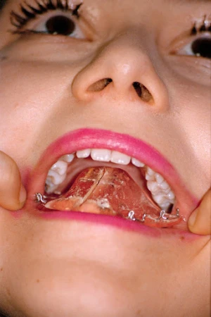 Close-up of a person's mouth with an upper dental prosthesis held in place, revealing teeth, lips, and surrounding facial features.