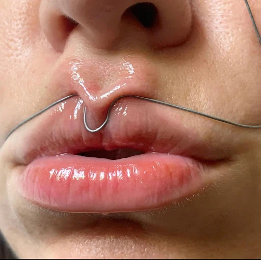 Close-up of an adult female face featuring the lips, nose, and a silver wire positioned above the upper lip, creating a curved shape.