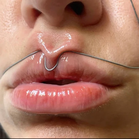 Close-up of an adult female face featuring the lips, nose, and a silver wire positioned above the upper lip, creating a curved shape.