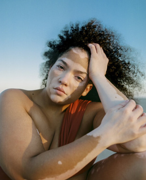 Close-up portrait of a biracial woman with curly hair and vitiligo, posing at the beach with a blue sky backdrop, showcasing natural beauty.