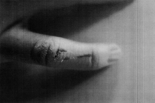 Close-up of a human thumb with visible skin damage and scarring on the thumb's surface, presented in black and white.