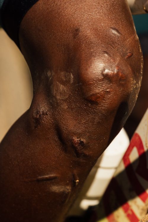 Close-up shot of an adult's dark-skinned leg, focusing on the knee and lower thigh, highlighting scarring and skin details in natural light.