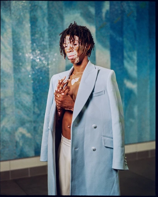 Adult male with dreadlocks and vitiligo poses in front of a blue wall wearing a double-breasted light blue coat and white pants.