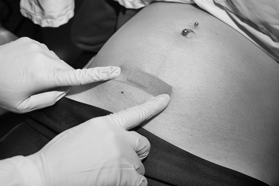 Close-up shot of hands in sterile gloves applying adhesive bandage on a person's torso with a visible navel piercing.