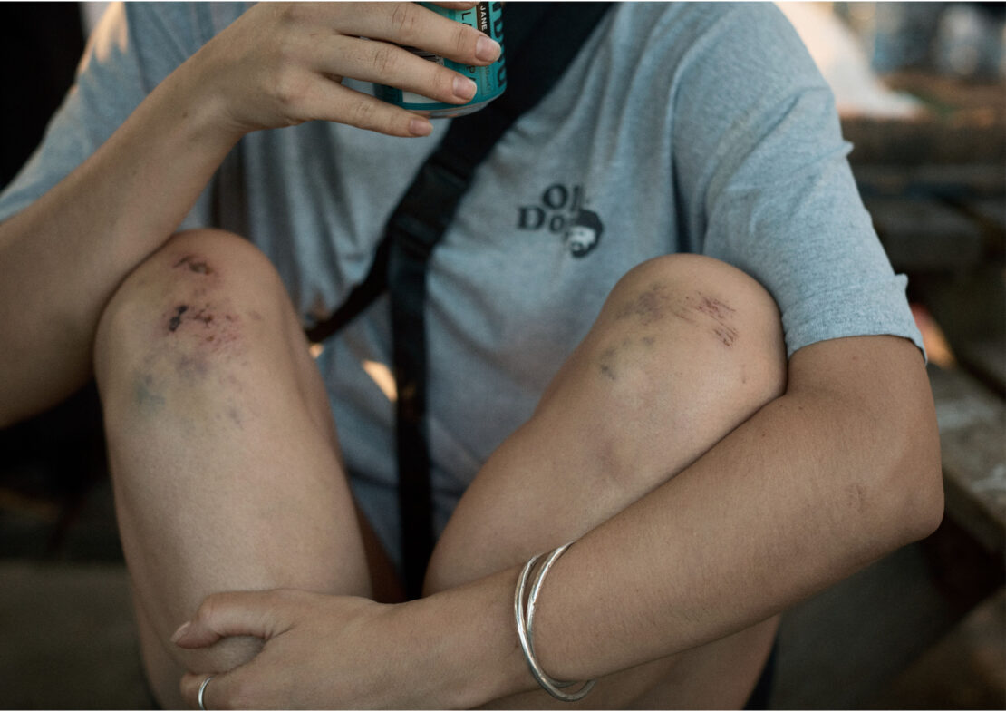 A young adult with scraped knees sits indoors wearing a grey t-shirt and silver bracelets while holding a beverage can.
