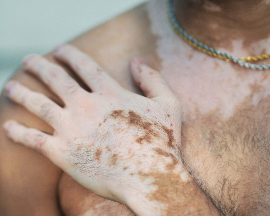 Close-up of an adult man's hand and upper chest with vitiligo, skin condition characterized by loss of pigment, wearing gold necklace.
