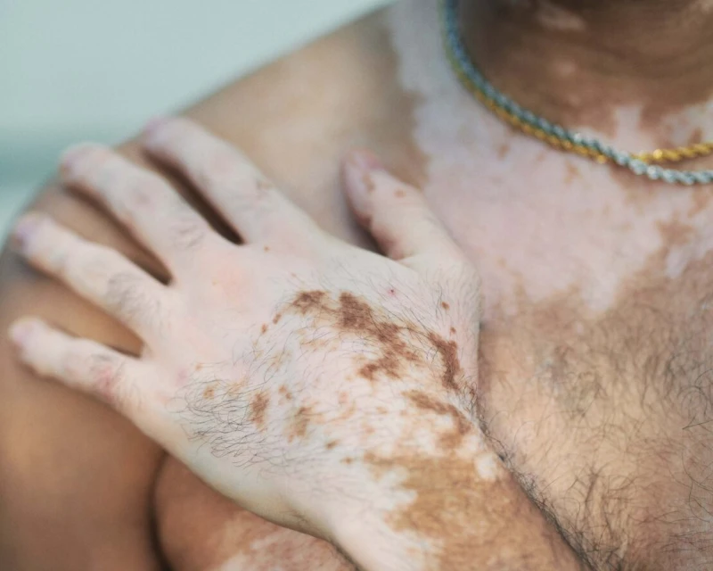 Close-up of an adult man's hand and upper chest with vitiligo, skin condition characterized by loss of pigment, wearing gold necklace.