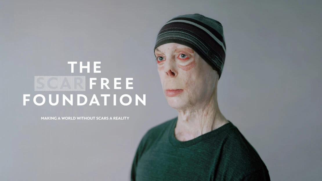 Portrait of an adult wearing a striped beanie and green shirt, next to the words: The Scar Free Foundation, Making a World Without Scars a Reality.