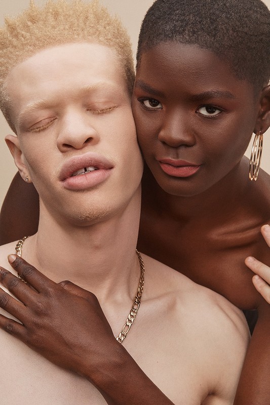 Two diverse women pose in a close-up studio shot. One woman with dark skin and gold hoop earrings embraces an albino woman with closed eyes.