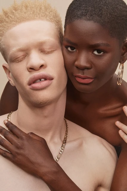 Two diverse women pose in a close-up studio shot. One woman with dark skin and gold hoop earrings embraces an albino woman with closed eyes.