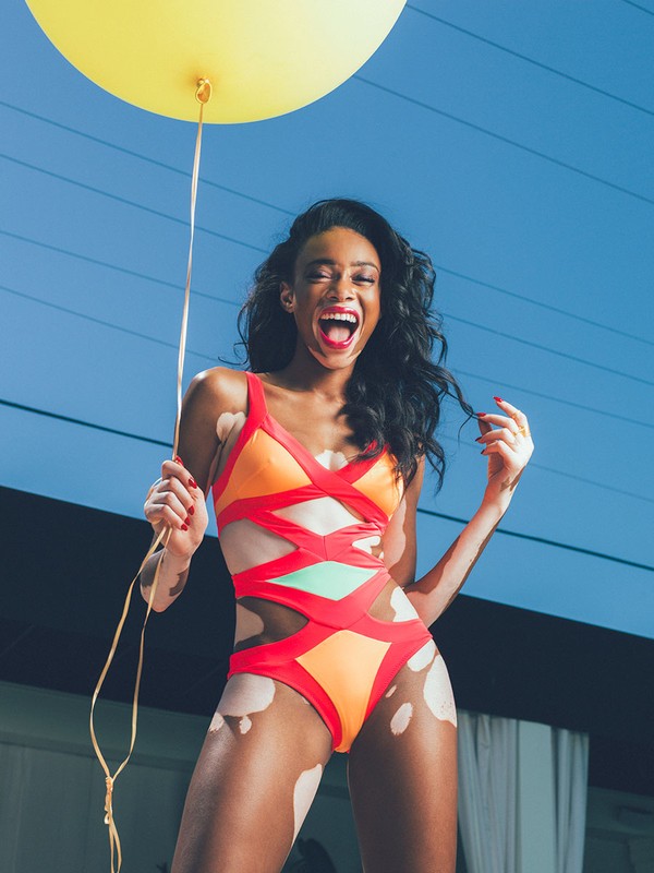 Woman with vitiligo posing in swimsuit, holding a yellow balloon against a blue sky with power lines, expressing joy and confidence.