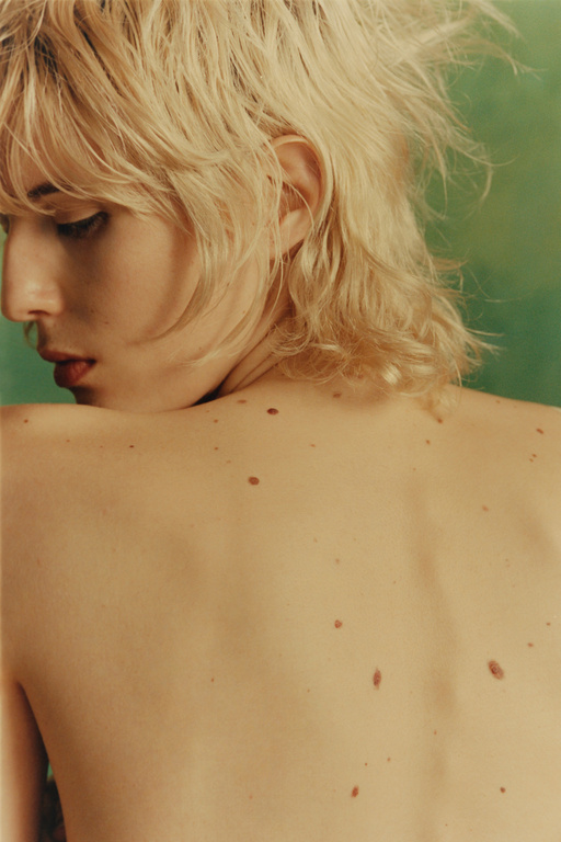Close-up of a fair-skinned young adult with blonde mullet, facing away, showing bare back and shoulders with moles on a green background.