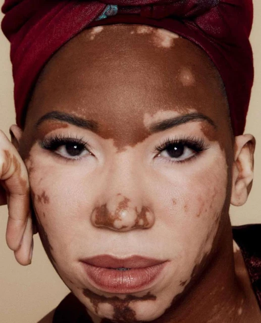 Close-up portrait of a woman with vitiligo wearing a burgundy head wrap, showcasing her unique skin and features in a beauty shot.