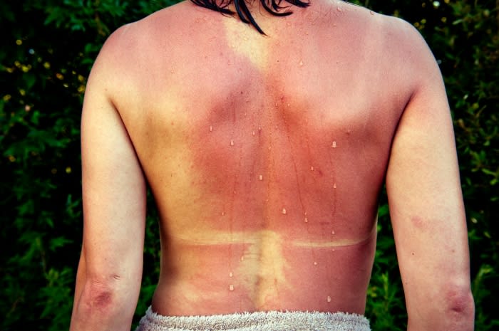 Close-up of an adult's back with sunburn, featuring red skin, white tan lines, and water droplets, set against a backdrop of green foliage.