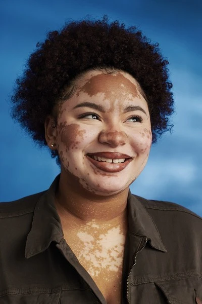 Portrait of an adult female with vitiligo, smiling and looking to the side, captured against a soft, cloudy blue backdrop in a studio.