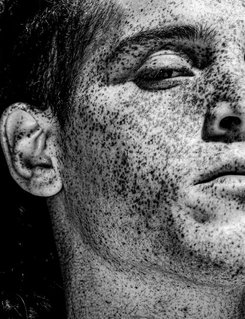Close-up black and white portrait of a human adult with dark hair, featuring their face and ear covered in many small spots.