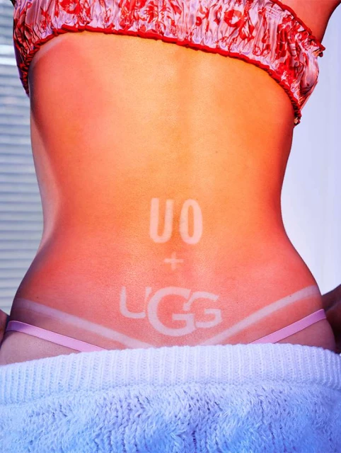 A fair-skinned person's back faces the camera with visible tan lines and the text 'UO + UGG' in a sun-tan effect.