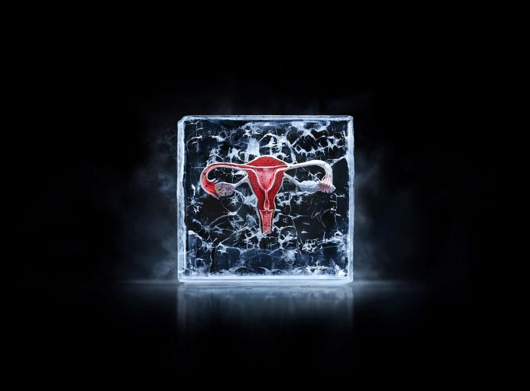 Uterus encased in cracked ice block on a black reflective surface with hazy vapor around the base and ice block, studio shot.