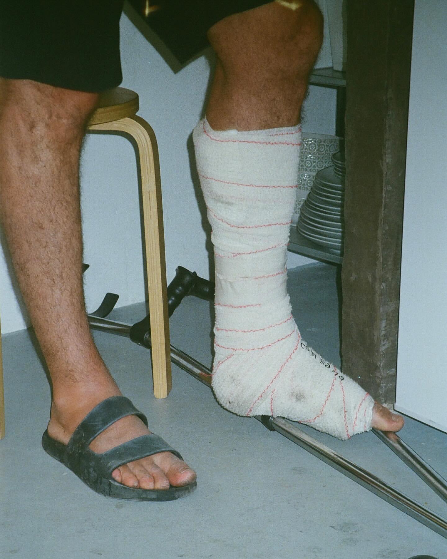 Person sitting with a heavily bandaged leg and foot, wearing casual sandals. The individual is seated indoors near a metal structure.