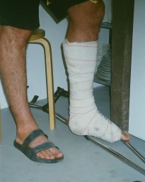 Close-up of a person's legs, one wrapped in a white medical cast resting on crutches next to a stool.