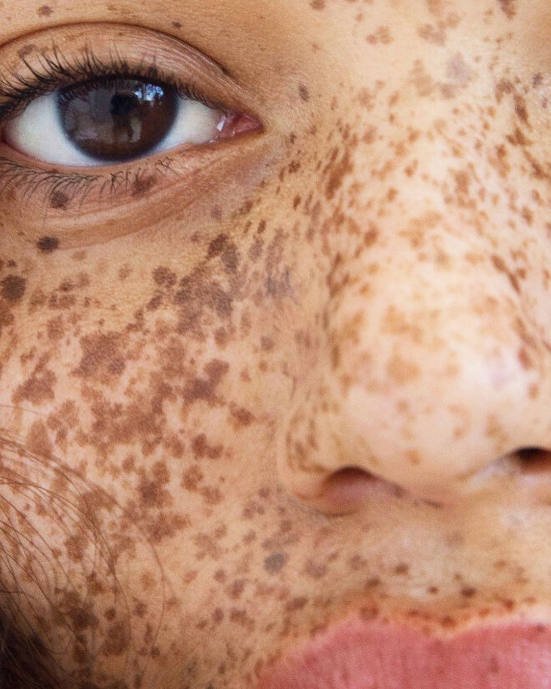 Close-up portrait of a fair-skinned adult female with dark freckles on her face, highlighting skin texture and a natural beauty aesthetic.