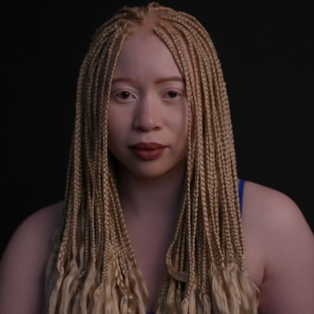 Portrait of albino woman with blonde braids, looking directly at the camera against a dark background in a beauty-style headshot.