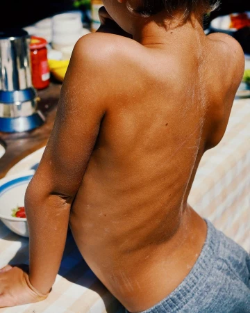 Child sitting with exposed back and shoulders, showing skin tone variations and detail; outdoor setting with table and kitchenware.