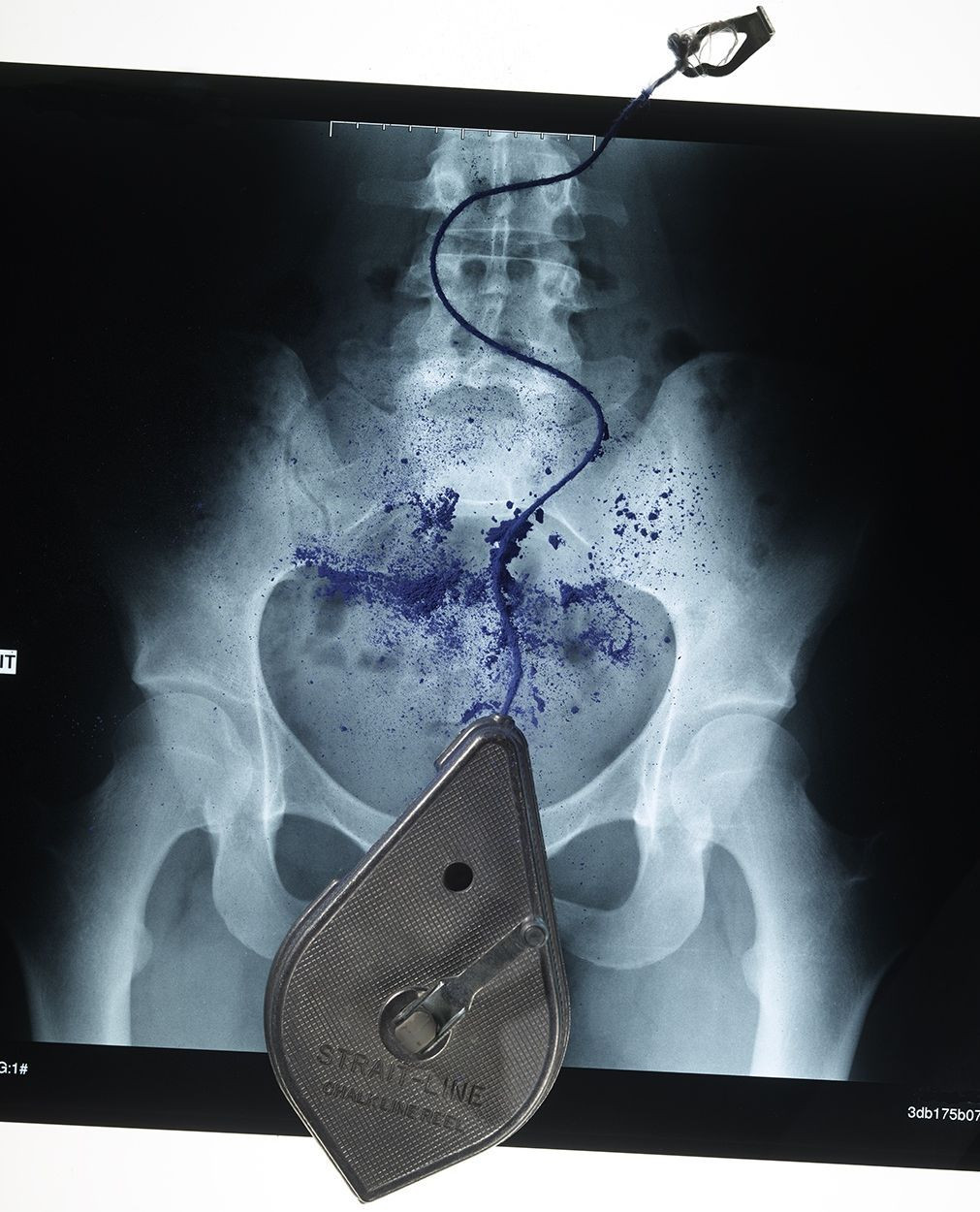 Radiology image featuring a chalk line reel and blue chalk dust over an X-ray of human pelvis, set against a clean white backdrop.