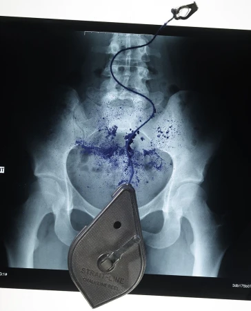 Radiology image featuring a chalk line reel and blue chalk dust over an X-ray of human pelvis, set against a clean white backdrop.