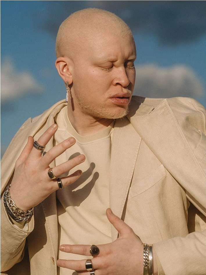 Close-up portrait of an albino male wearing an open beige jacket, t-shirt, silver jewelry, and rings, set against a light blue sky.