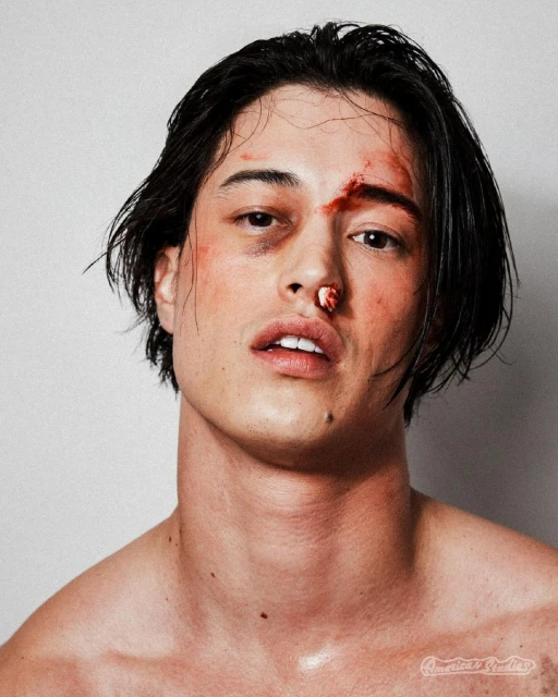 Close-up portrait of a young adult male with visible injuries including a cut on his forehead, a bloody nose, and bruising around his eye.