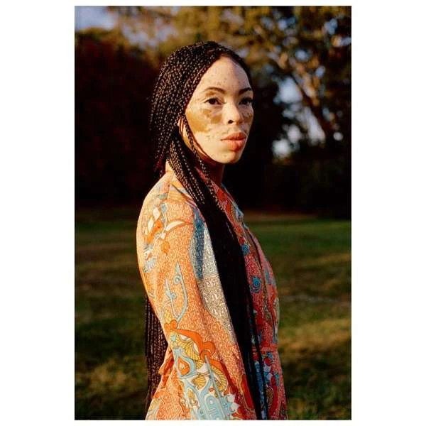 Portrait of an adult woman with vitiligo wearing an orange patterned robe, styled hair braids, shot outside with trees in the background.