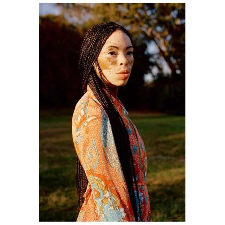 Portrait of an adult woman with vitiligo wearing an orange patterned robe, styled hair braids, shot outside with trees in the background.