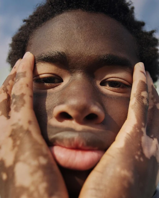 Close-up portrait of a young adult man with vitiligo holding his hands to his face, set against a blurred sky background.