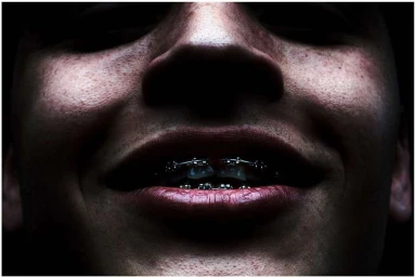 Extreme close-up portrait of a person smiling, revealing dental braces on their teeth under dramatic low-key lighting.