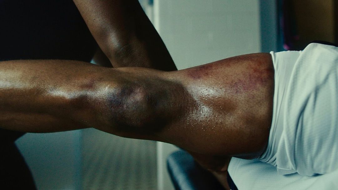 Close-up of a dark-skinned adult male athlete receiving massage therapy, focusing on the injured, bruised knee and leg in a bright interior.