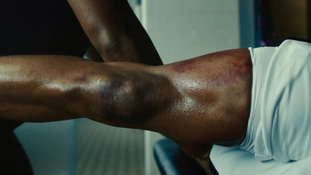 Close-up of a dark-skinned adult male athlete receiving massage therapy, focusing on the injured, bruised knee and leg in a bright interior.