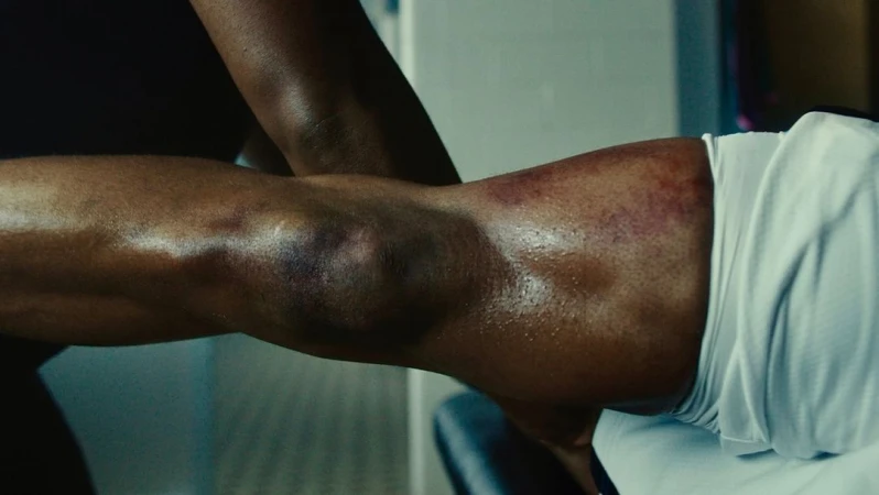 Close-up of a dark-skinned adult male athlete receiving massage therapy, focusing on the injured, bruised knee and leg in a bright interior.
