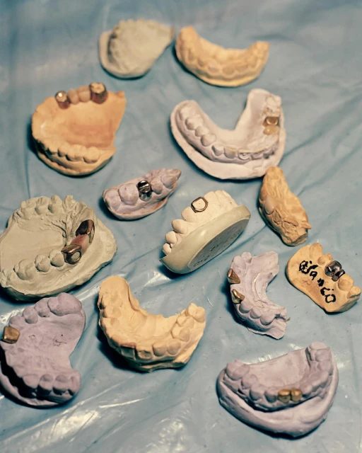 Multiple dental casts, some with metal attachments, arranged on a blue surface, showcasing dental prosthetics and dental technology.