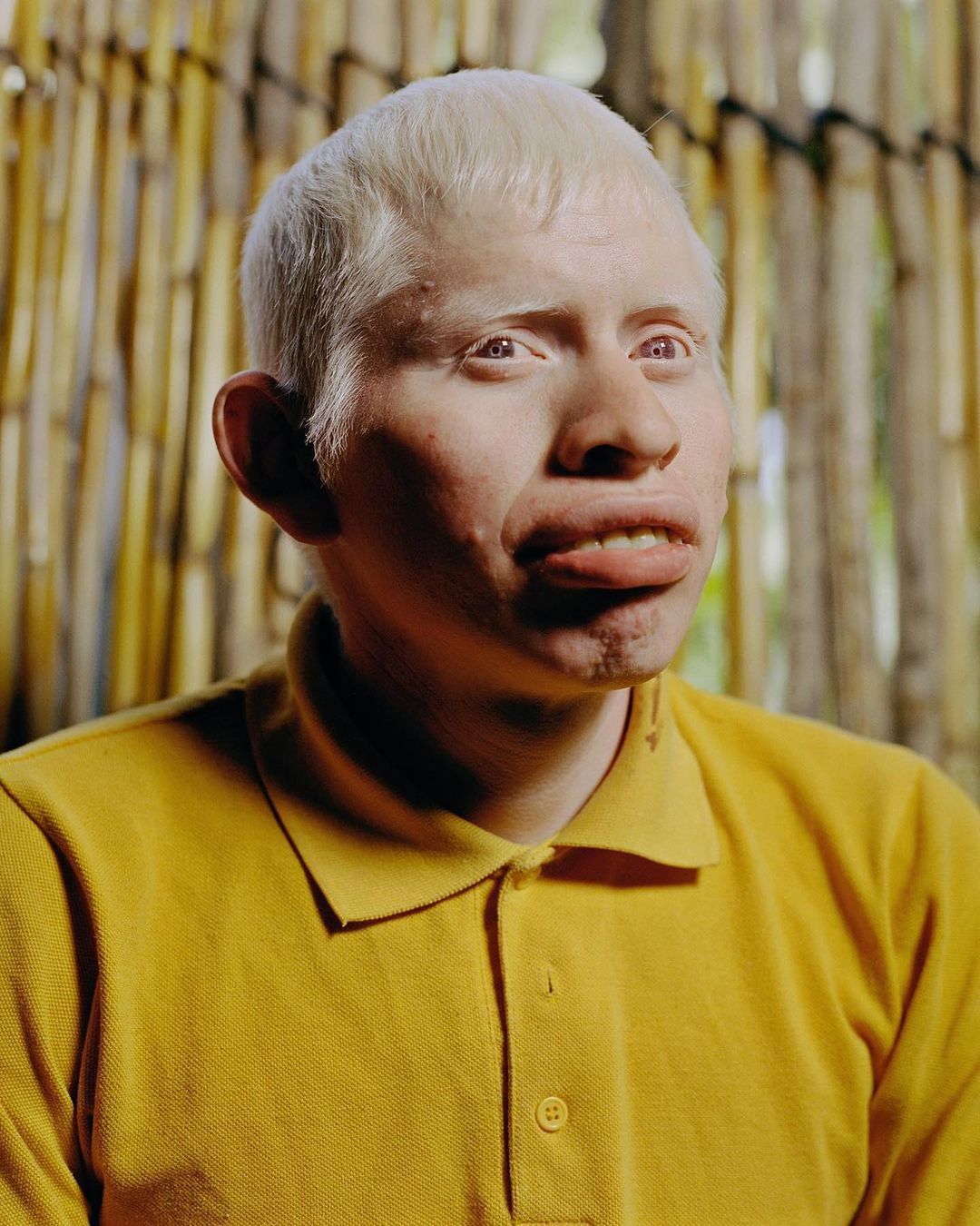 Close-up portrait of an adult albino male with blond hair, wearing a yellow collared shirt. Background features straw-like decor.