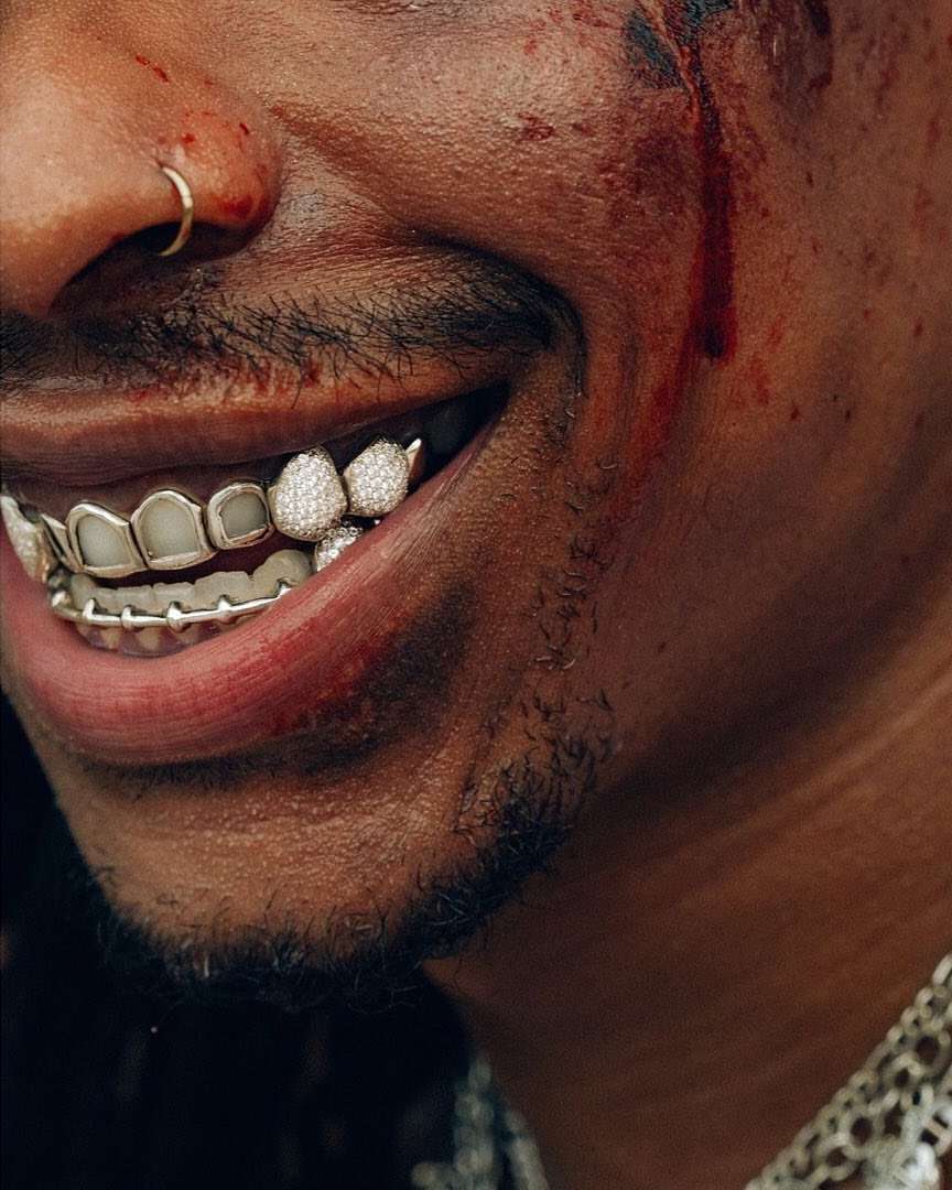 Close-up of a man smiling, showing his dental grills, a gold nose ring, and cuts on his temple and cheekbone.
