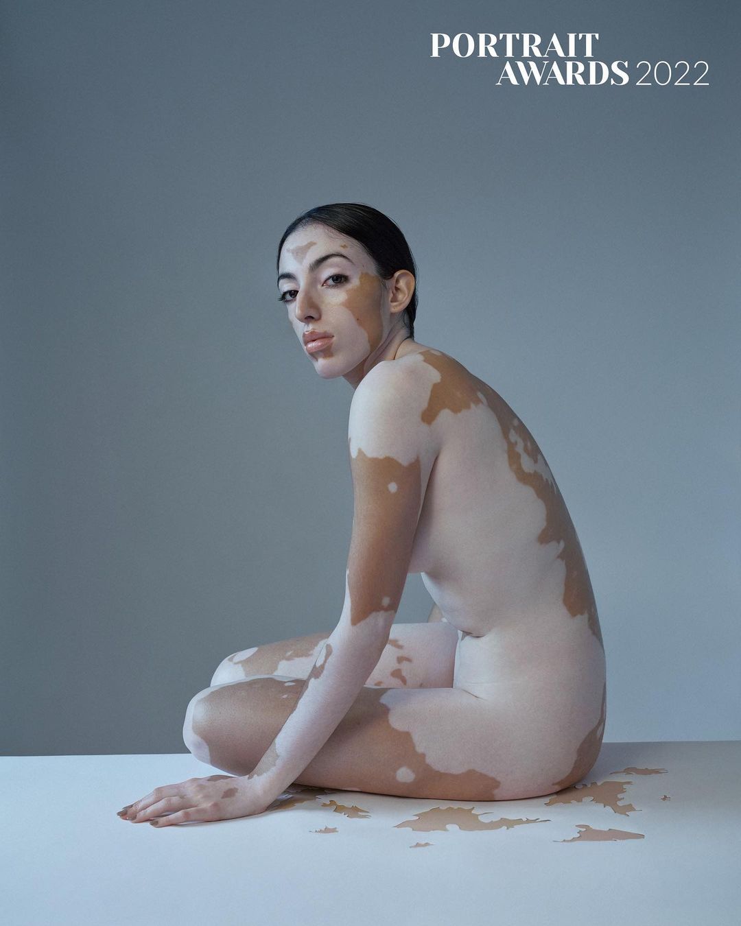 Portrait of an adult female with vitiligo, seated in a neutral setting. The image highlights her skin condition with soft lighting.