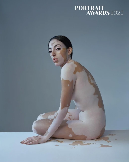 Portrait of an adult female with vitiligo, seated in a neutral setting. The image highlights her skin condition with soft lighting.