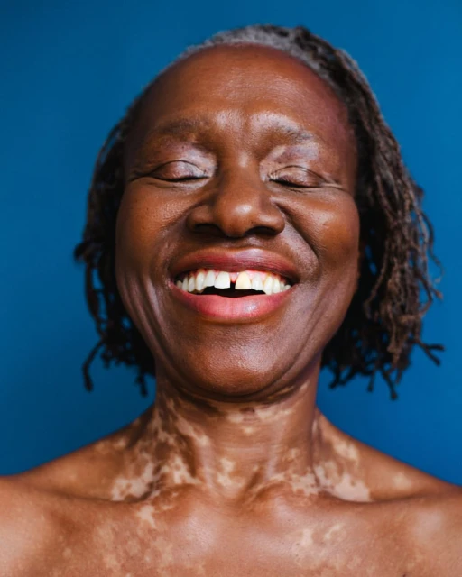 Close-up portrait of a smiling older Black woman with her eyes closed, showcasing vitiligo skin condition against a blue background.